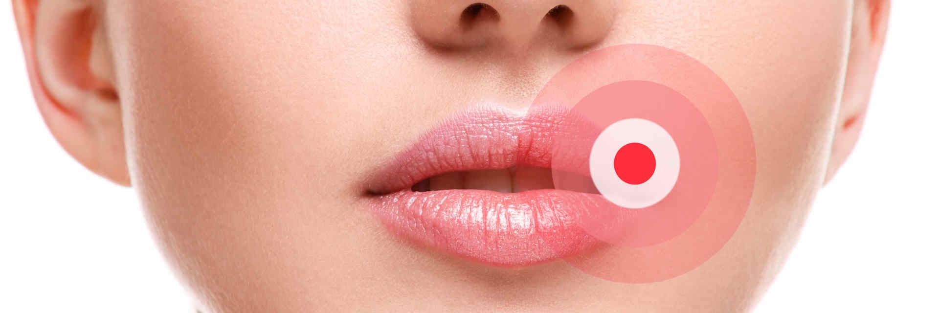 Lips showing where cold sores can appear